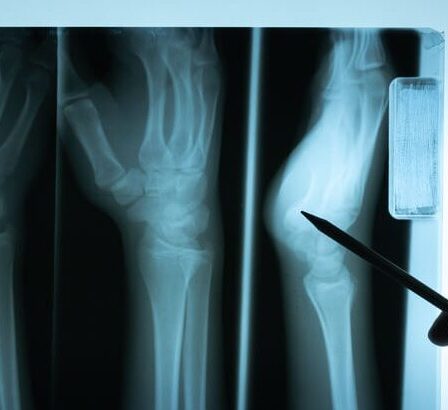 imagenes de osteomielitis