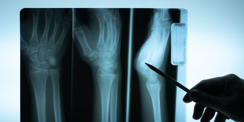 imagenes de osteomielitis