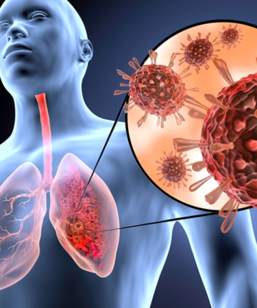 alérgia y una infección respiratoria