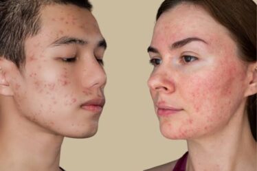 mujer y hombre con acné