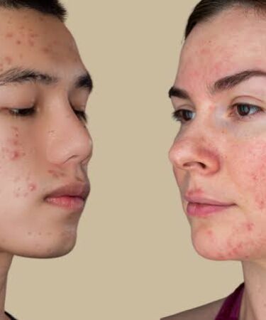 mujer y hombre con acné