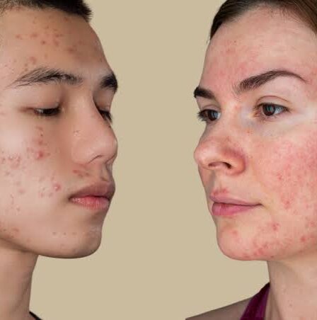 mujer y hombre con acné